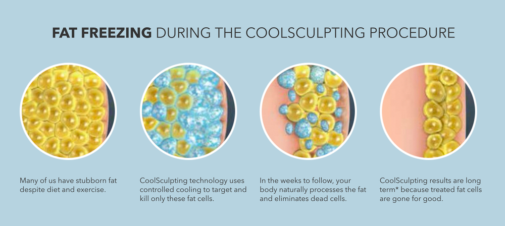 what is coolsculpting, About CoolSculpting